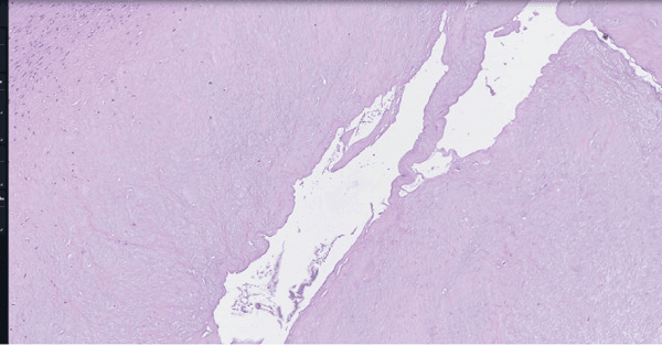 Low-power histological section of a ganglion wall: dense fibrous tissue around a slit-like cavity with no epithelial lining