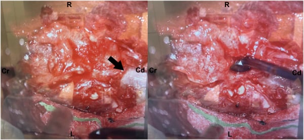 Two operative photographs with orientation labels R, L, Cr and Cd: an arrow on a haemorrhagic lumbar synovial cyst, and a dissector in the plane beside it