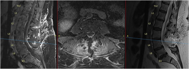 Postoperative sagittal and axial lumbar MRI with levels labelled after complete synovial cyst resection