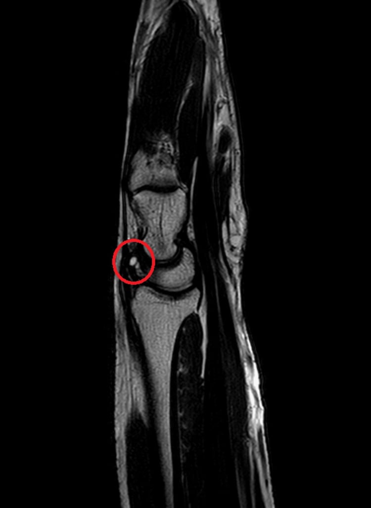 Sagittal wrist MRI with a red circle around a small high-signal lesion beside the radiocarpal joint