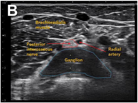 Labelled ultrasound, panel B: the posterior interosseous nerve compressed between brachioradialis and a large ganglion, beside the radial artery