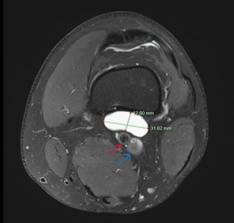 Axial knee MRI showing a posterior ganglion measured at 31.62 by 12.60 mm lying immediately anterior to the popliteal artery and vein (red and blue arrows)