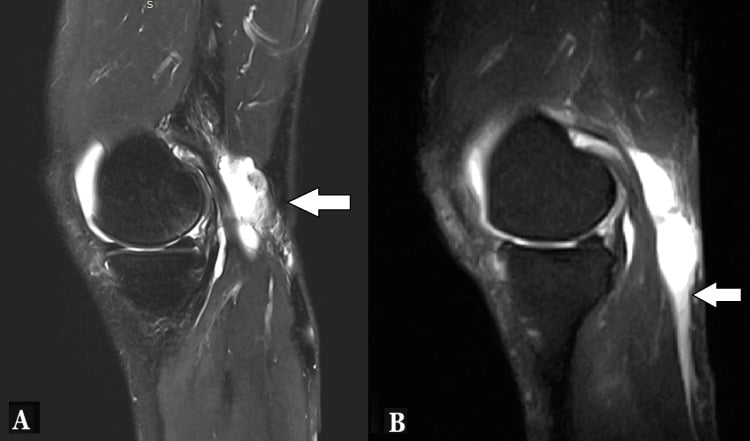 Two sagittal knee MRI panels, A and B, with arrows on an irregular posterior fluid collection tracking distally into the calf