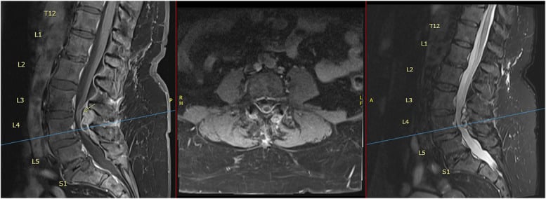 Preoperative T1 and T2 axial and sagittal MRI demonstrating lumbar facet synovial cyst