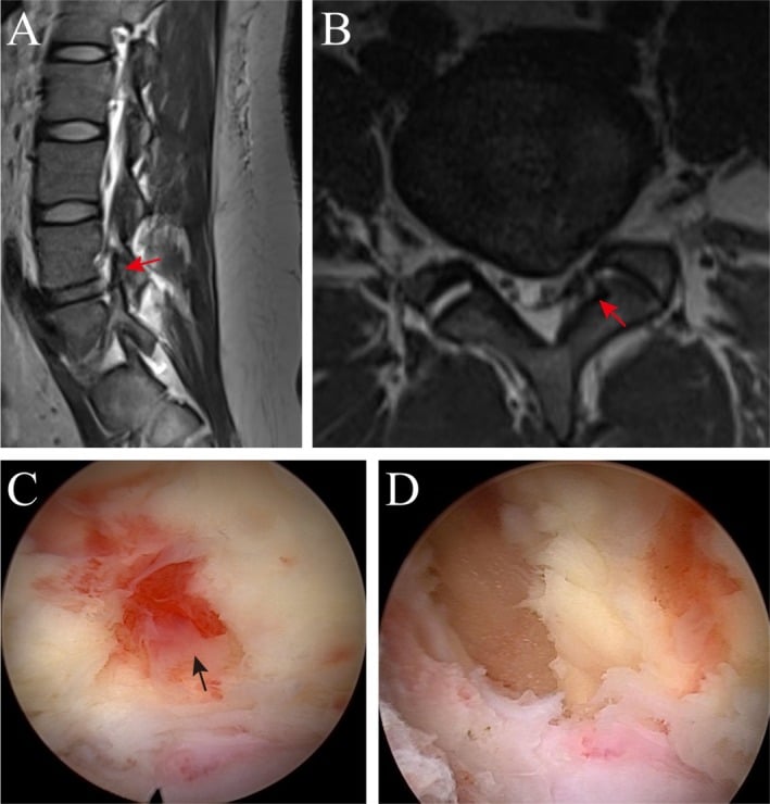 Sagittal and axial T2 MRI demonstrating lumbar synovial cyst spinal stenosis