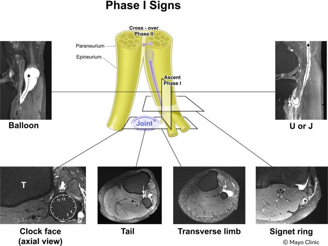 MRI diagnostic roadmap for intraneural synovial cysts