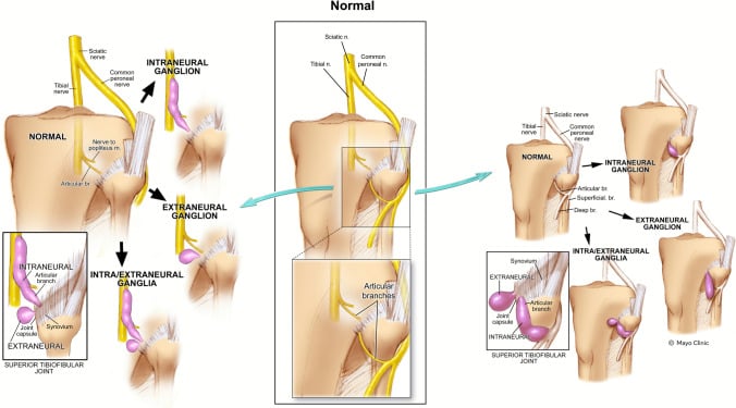 Anatomical diagram of articular branch path in intraneural synovial cyst
