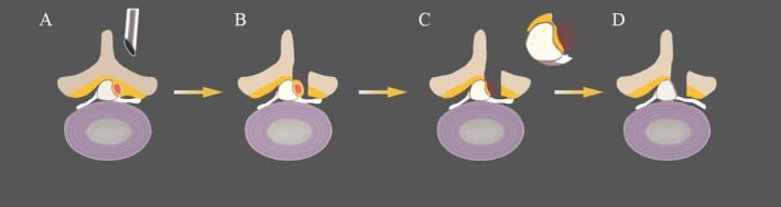 Full endoscopic surgical resection of lumbar synovial cyst