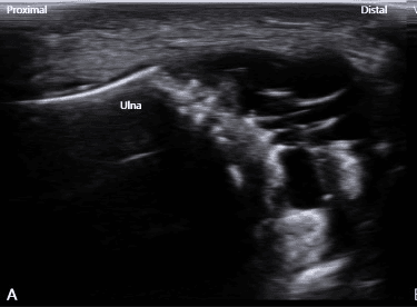 Longitudinal ultrasound, panel A, labelled proximal, distal and ulna, showing a well-defined multiseptated anechoic ganglion distal to the ulna, beside the TFCC