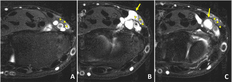 Three serial axial wrist MRI panels, A to C, showing a lobulated volar ganglion (arrows, asterisk) against the radial artery and its bifurcation (arrowheads)