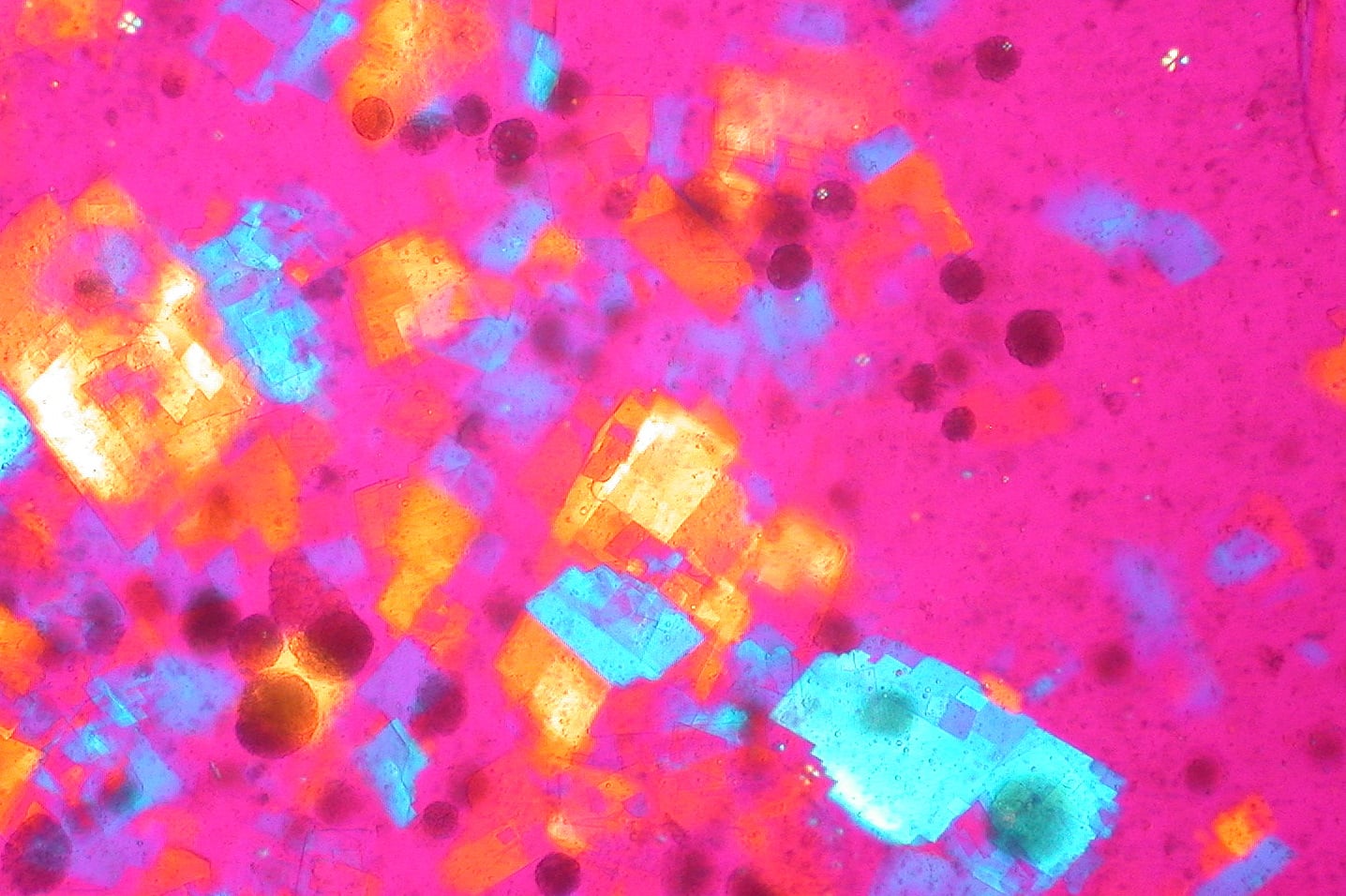 Crystals in synovial fluid viewed under polarised light microscopy.