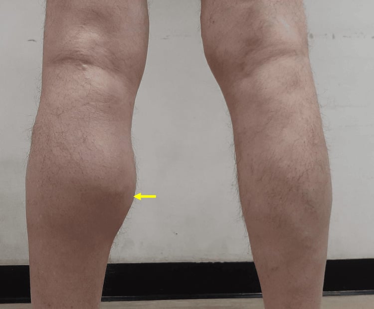 Clinical photograph showing a posterior popliteal mass in a patient with a Baker cyst