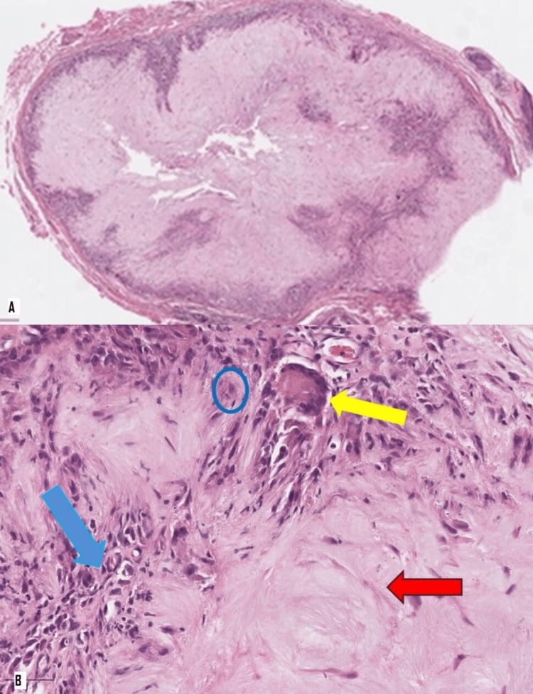 Histological section of a gouty tophus showing crystalline core and giant-cell reaction