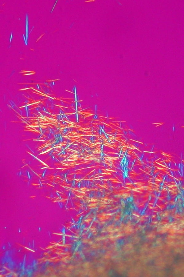 Compensated polarized light microscopy of needle-shaped monosodium urate crystals