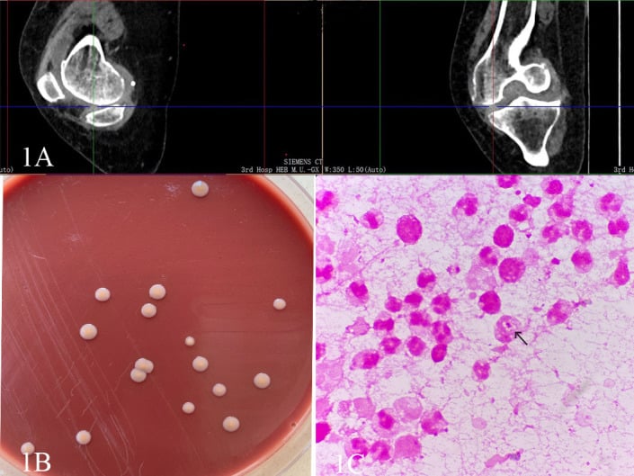 CT image of joint effusion and culture plate showing bacterial growth in septic arthritis