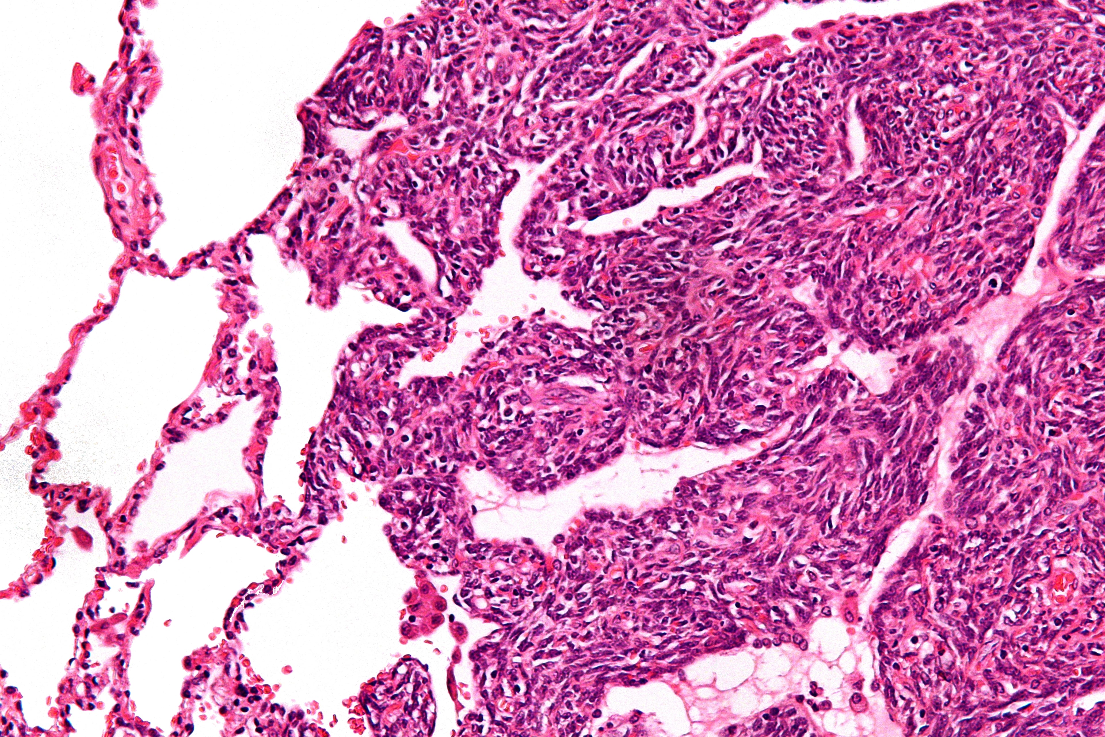 H&E micrograph of monophasic synovial sarcoma metastatic to lung.
