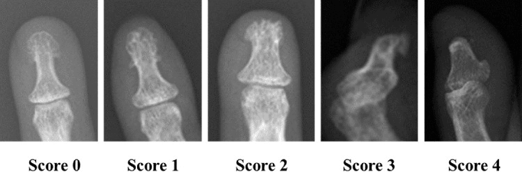 Radiographic series of terminal phalanges showing acro-osteolysis scores 0 to 4 from normal tuft to resorption of the entire terminal phalanx