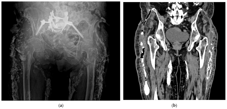 Plain radiograph showing multiple calcifications along the hips and CT demonstrating gas adjacent to a calcified mass in calcinosis cutis universalis