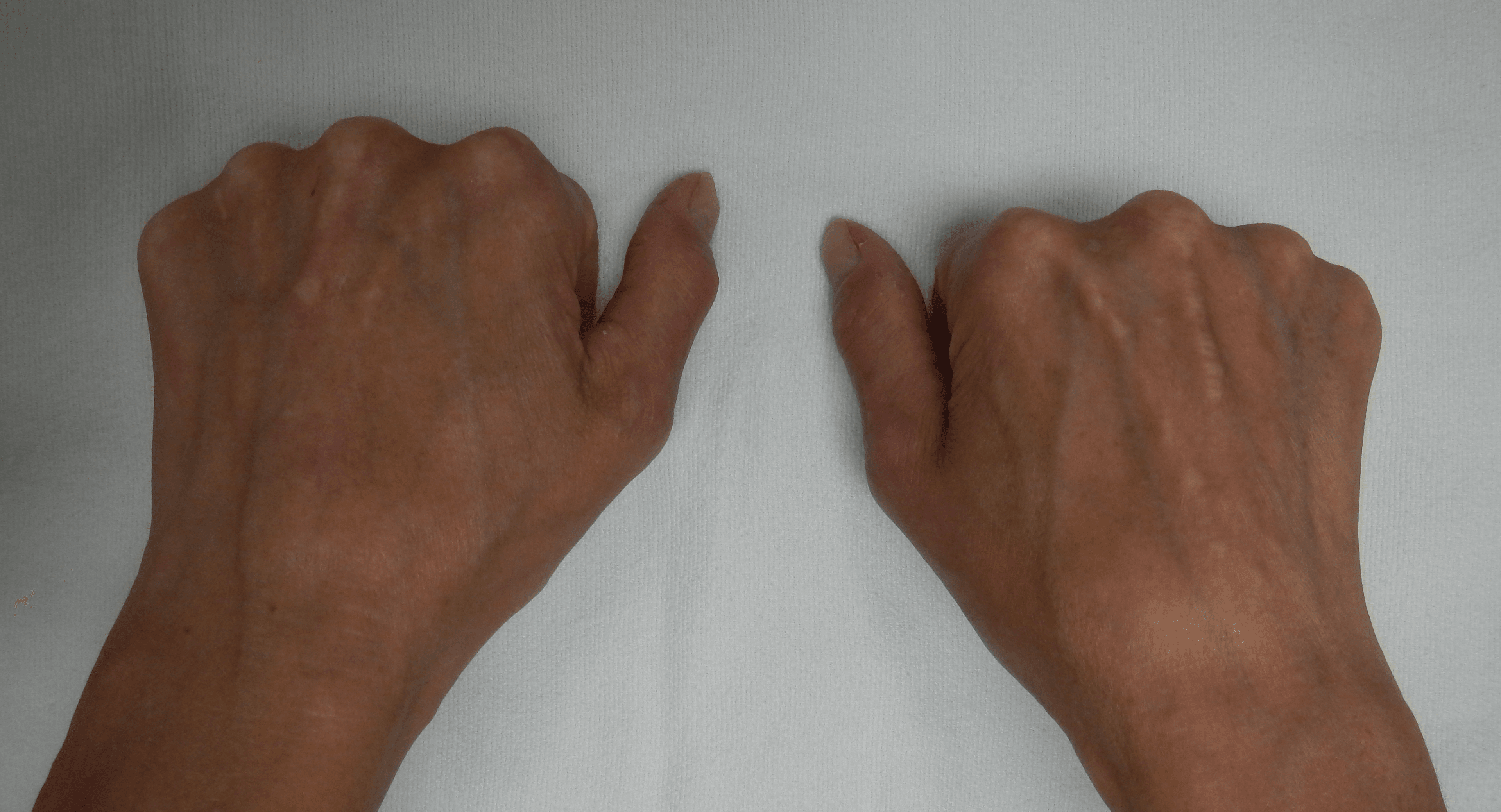 Photograph of both clenched fists showing fixed flexion contractures in CREST syndrome