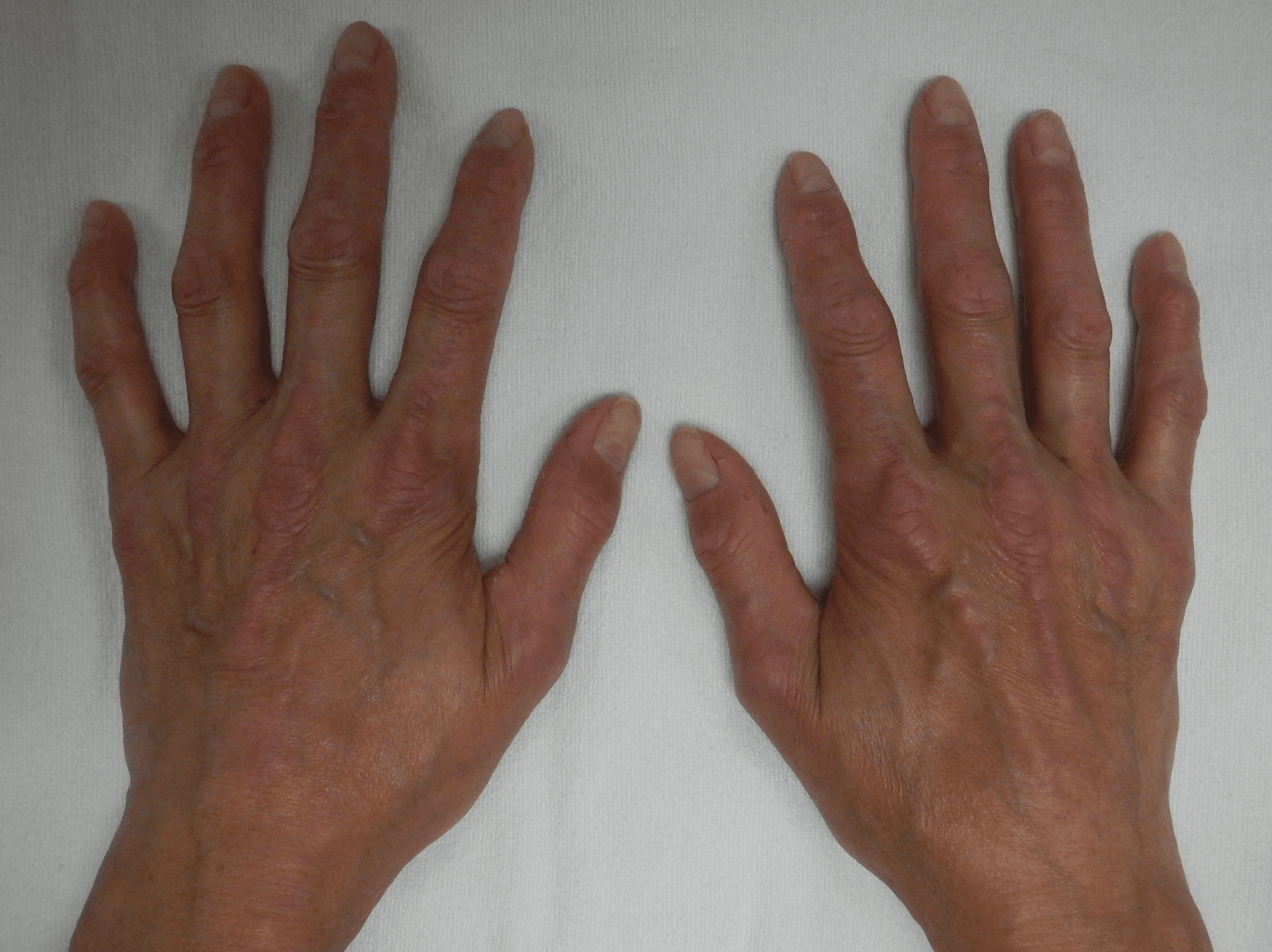 Photograph of both hands in CREST syndrome showing sclerodactyly and subcutaneous calcinosis