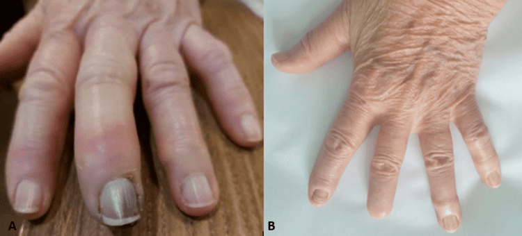 Photographs of a fingertip showing early digital necrosis and the hand after autoamputation of the distal phalanx