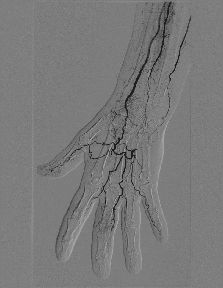 Digital subtraction angiogram of the hand showing obliterative changes of the distal ulnar artery and palmar arch