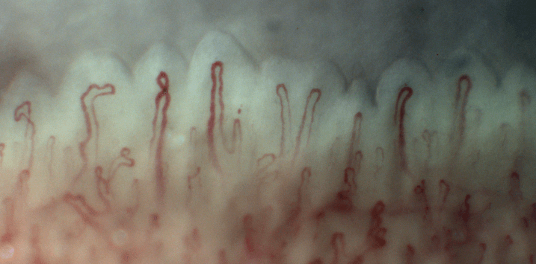 Nailfold videocapillaroscopy image showing the capillary loops of the finger nailfold