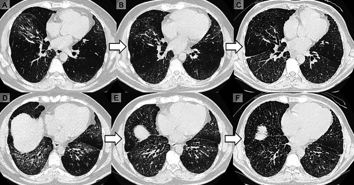 Serial chest CT at two axial levels over three time points showing progressive basilar reticulation with traction bronchiectasis in systemic sclerosis interstitial lung disease
