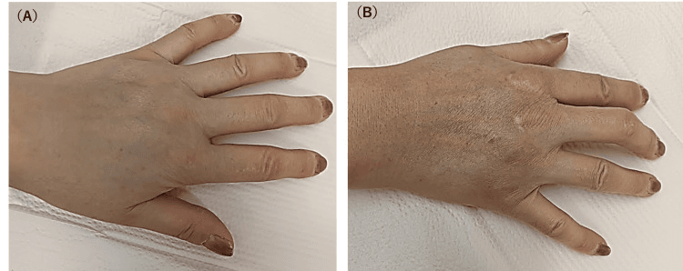 Photograph of the wrist and hand in resting and flexed positions showing skin sclerosis extending from fingers to palm with mild flexion deformity
