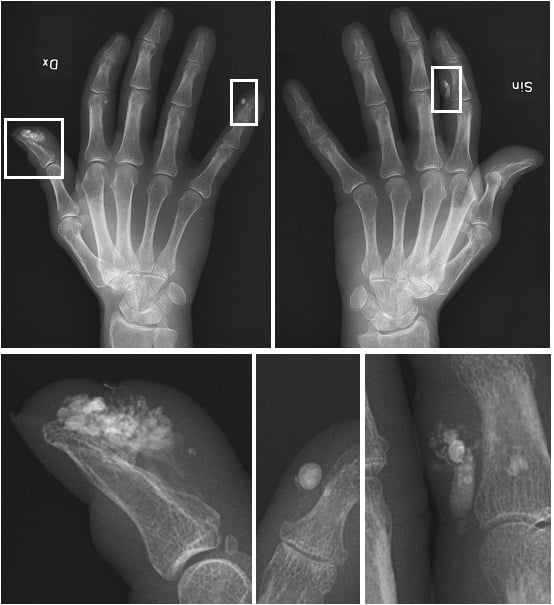 Hand radiographs of CREST syndrome showing subcutaneous calcinosis deposits in the digits