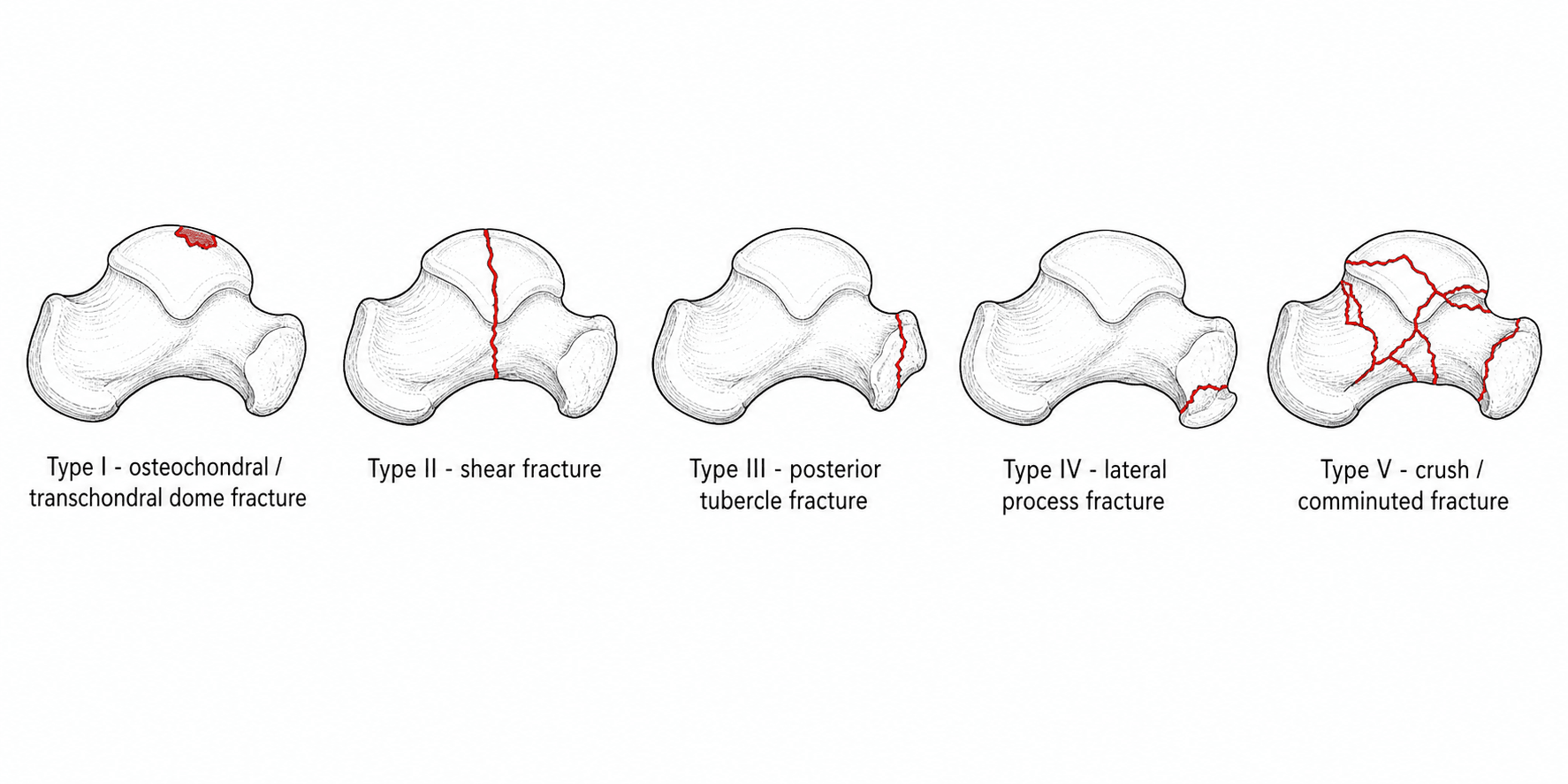 Five-panel diagram of the Sneppen classification of talar body fractures