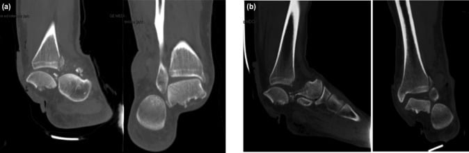 Coronal CT of bilateral talar body fracture-dislocations