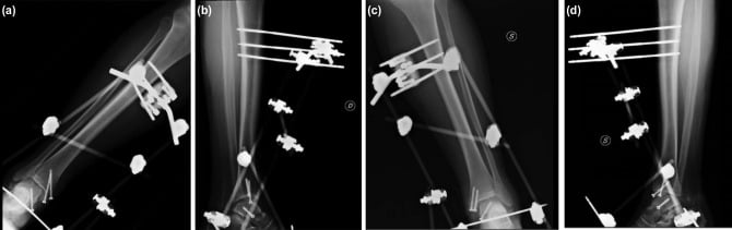 Postoperative radiographs of bilateral talar body fracture fixation
