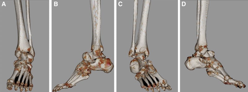 Three-dimensional CT of pantalar dislocation with talar body fracture