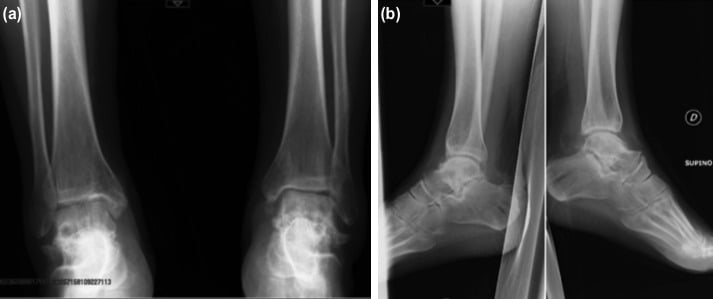 Long-term radiographs showing talonavicular and subtalar arthritis after talar fractures