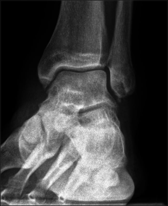 Six-month mortise radiograph without talar avascular necrosis