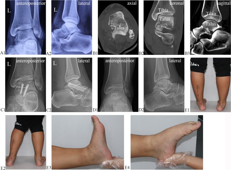 Preoperative radiograph and CT with serial follow-up after talar-body fixation