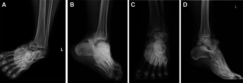 Radiographs of talar fracture-dislocation with trimalleolar injury before and after reduction