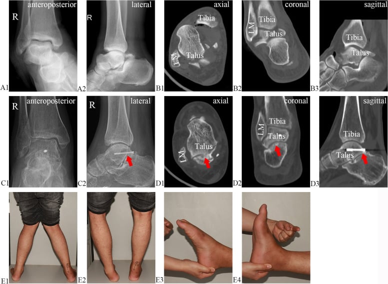 Preoperative talar-body CT and 18-month postoperative subtalar arthritis