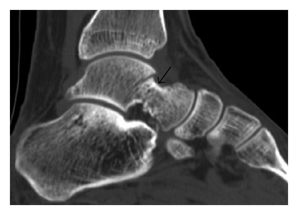Sagittal CT of the hindfoot showing a talar fracture indicated by an arrow