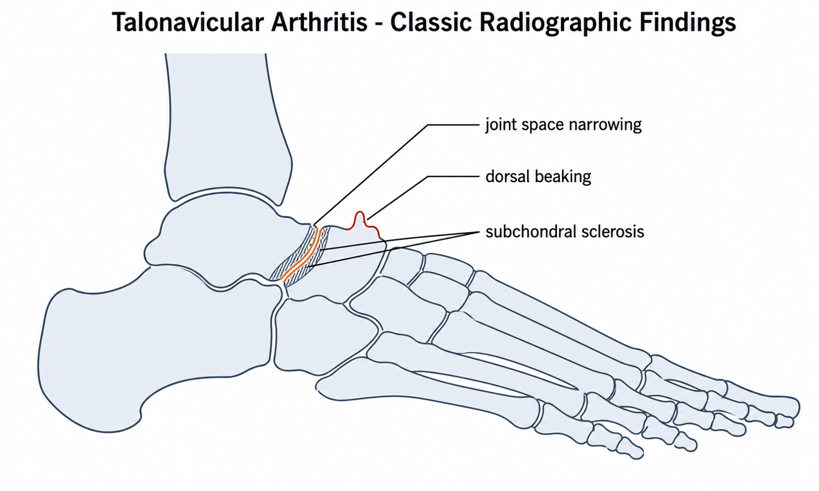 Lateral foot schematic labelling the classic radiographic findings of talonavicular arthritis: joint space narrowing, dorsal beaking, and subchondral sclerosis.
