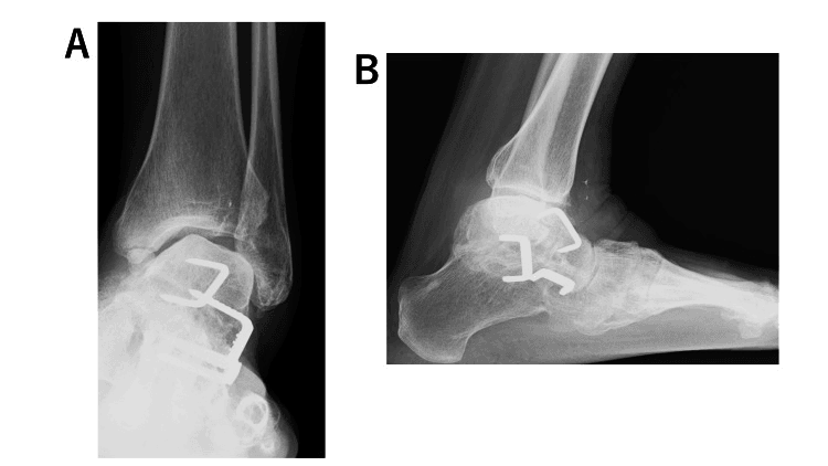 Frontal (A) and lateral (B) radiographs showing ankle instability after prior triple arthrodesis fixed with staples