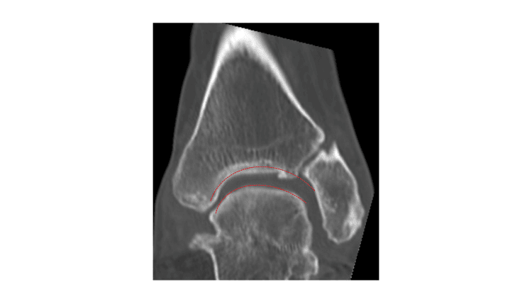 Coronal CT showing a rounded talus and ball-and-socket ankle morphology, the talar dome and plafond outlined in red