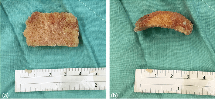 Femoral-head allograft before (a) and after (b) shaping into a curved strut to reconstruct navicular collapse, beside a ruler