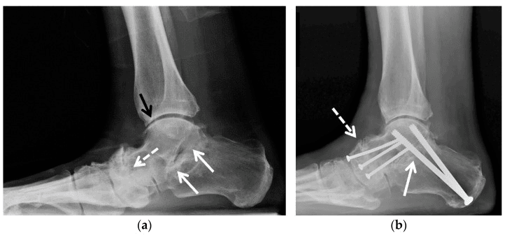 Preoperative (a) and postoperative (b) lateral radiographs of severe talonavicular and subtalar arthritis treated with double arthrodesis