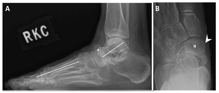 Standing lateral (A) and dorsoplantar (B) radiographs of Maceira stage 4 Müller-Weiss disease, with the Meary-Tomeno angle drawn on the lateral view and the navicular labelled N