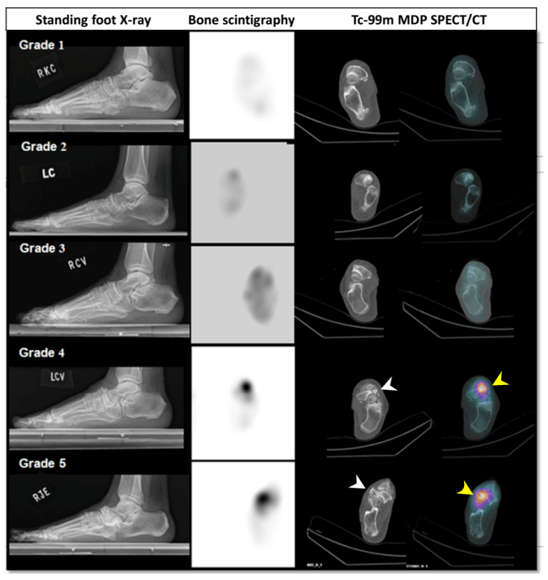 Grades 1 to 5 of Müller-Weiss disease on standing lateral radiographs, bone scintigraphy and Tc-99m MDP SPECT/CT, showing progressive navicular deformity and fragmentation, with focal talonavicular tracer uptake marked by arrowheads at grades 4 and 5