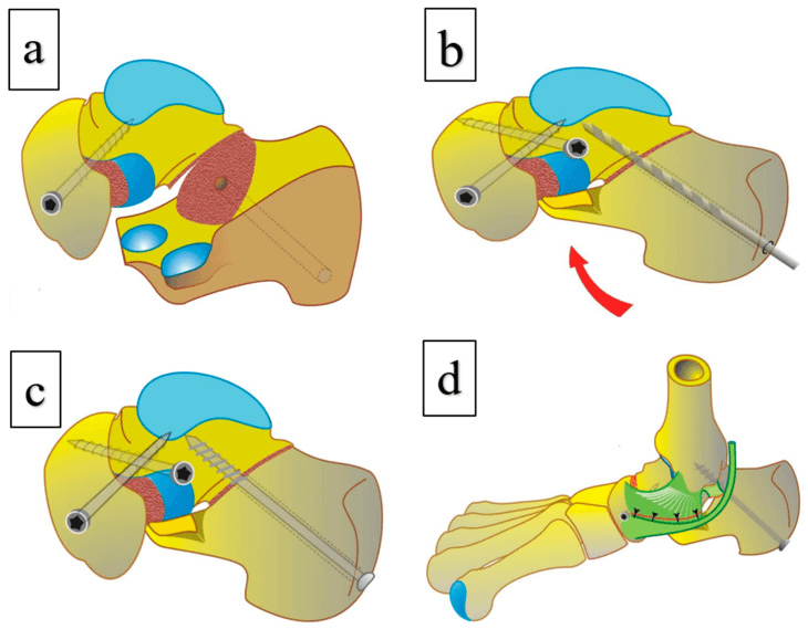 Schematic panels a to d of the compression screw construct for talonavicular and subtalar arthrodesis