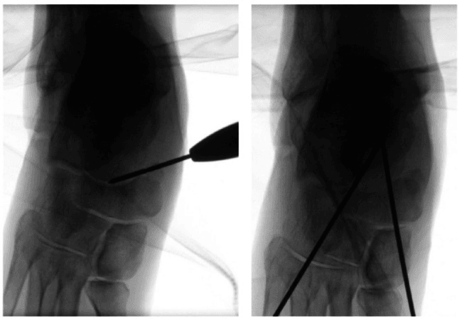 Fluoroscopic images of minimally invasive talonavicular preparation and temporary K-wire transfixion
