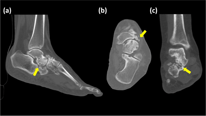 Sagittal (a), axial (b) and coronal (c) CT of Müller-Weiss navicular osteonecrosis, arrows marking navicular fragmentation and subtalar cystic arthritis